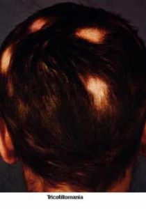 Tricotillomania